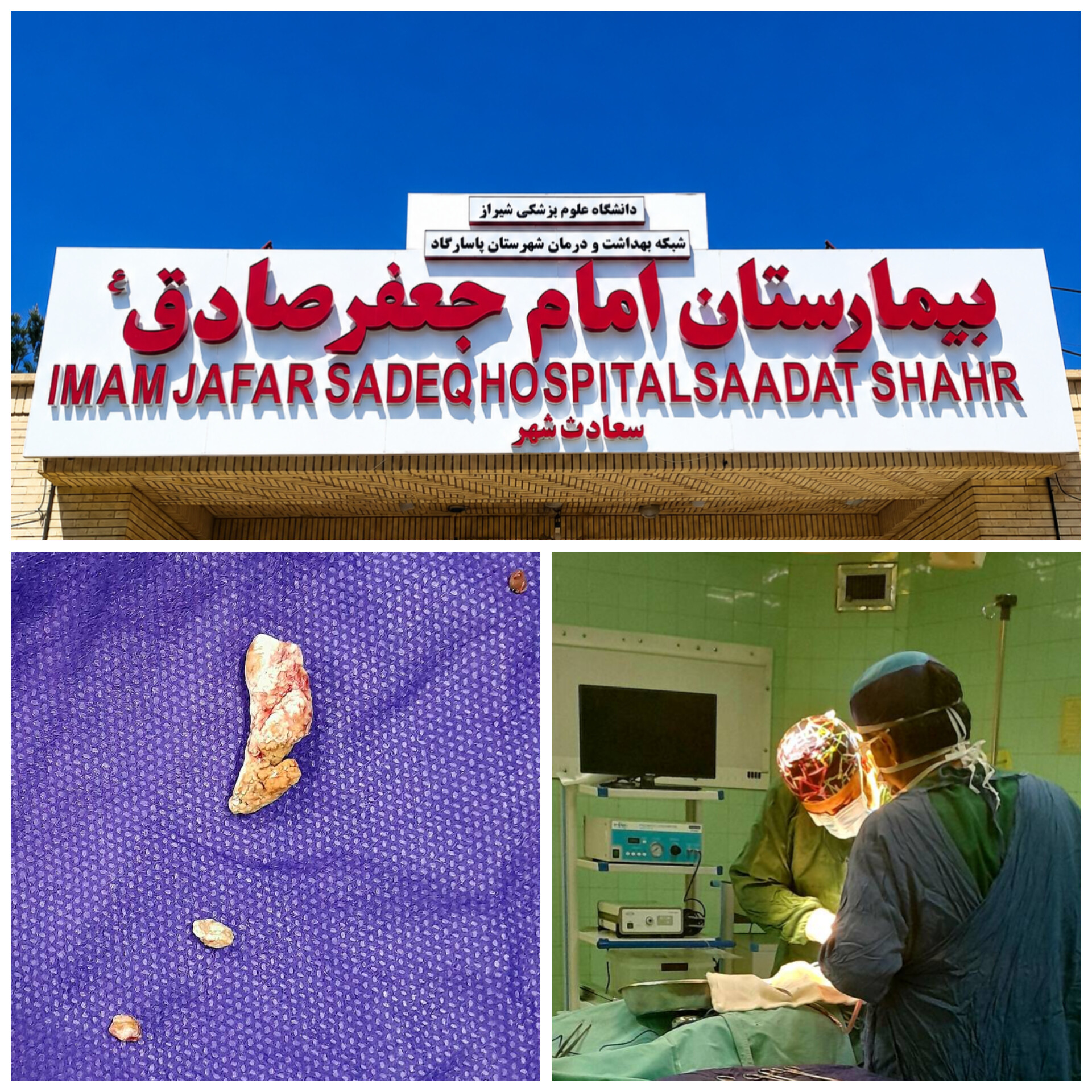 خارج کردن موفقیتآمیز سنگ لگنچه کلیه از بیمار ۵۴ ساله در بیمارستان امام جعفر صادق(ع) سعادتشهر