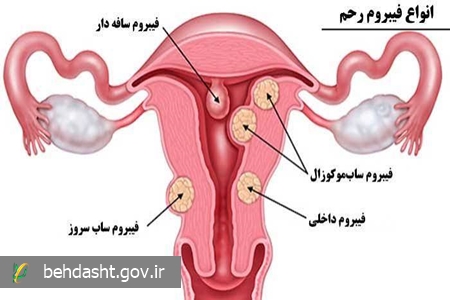 فیبروم&zwnj;های رحمی؛ از خون&zwnj;ریزی&zwnj;های غیرطبیعی تا اختلال در باروری
