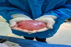 عمل جراحی اورژانسی کیست تخمدان با موفقیت در بیمارستان امام جعفر صادق(ع) پاسارگاد انجام شد