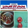 نخستین عمل جراحی باز پروستات همراه با خروج ۱۳ عدد سنگ مثانه در بیمارستان پاسارگاد با موفقیت انجام شد